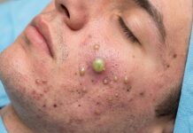 Acne Blackheads Extraction Whiteheads