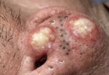 Big Cystic Blackheads Whiteheads