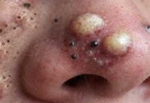 Big Cystic Blackheads Extraction Whiteheads