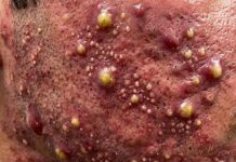 Cystic Acne Blackheads Extraction