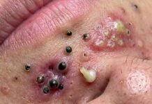 Blackheads Extraction Whiteheads