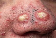 Big Cystic Blackheads Extraction Whiteheads